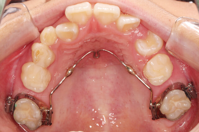 症例紹介】混合歯列期に非抜歯で矯正治療を開始した10代女性 | 浦安駅3