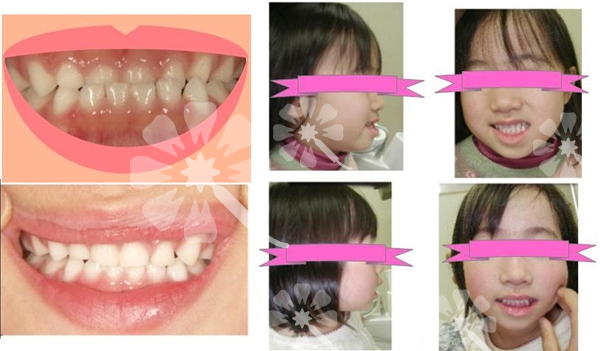 仙台 矯正歯科 歯列矯正 堀歯科医院