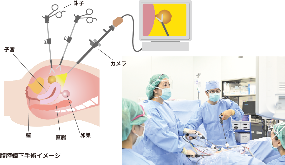 内視鏡・ロボット手術部門（腹腔鏡手術・子宮鏡手術） | 女性医療