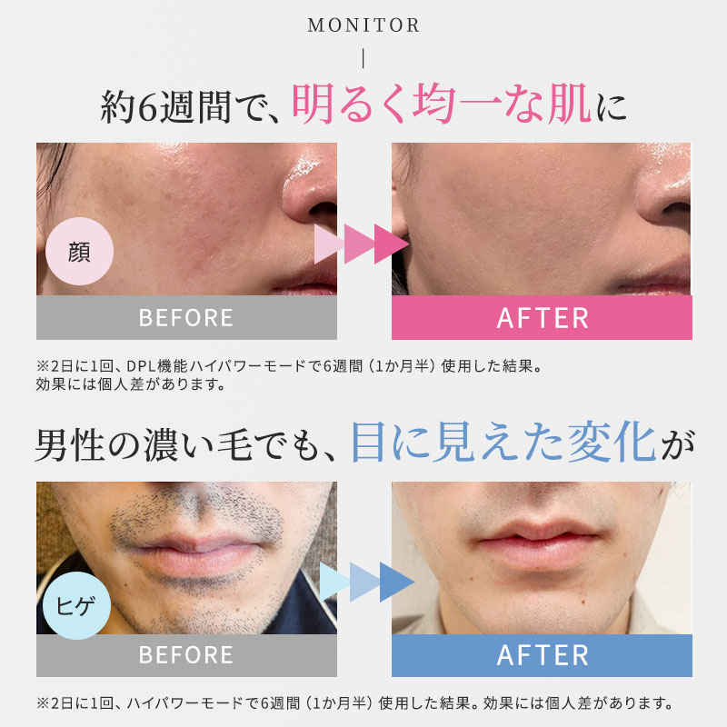 楽天市場】【送料無料/正規品】マイトレックス ミライ 光美容器 MT