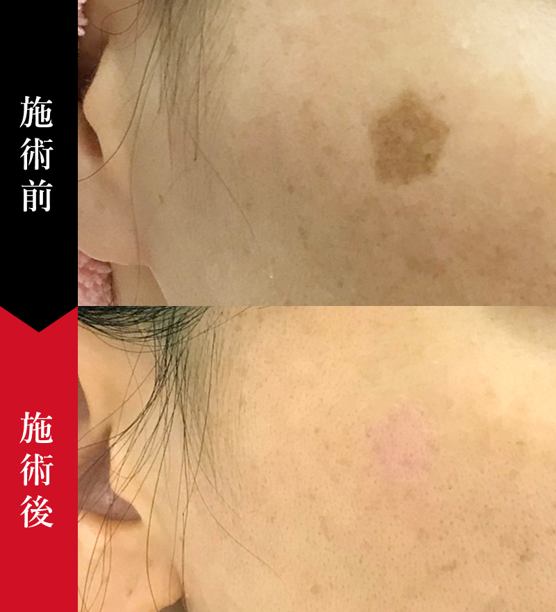 シミ取りレーザー (シミ取り放題)の症例｜椿クリニック 銀座・名古屋