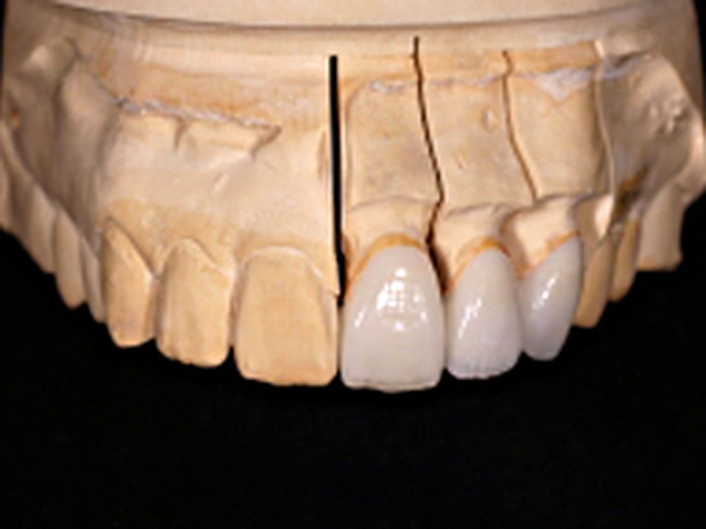 事例集｜京都市右京区 歯科技工所カリス