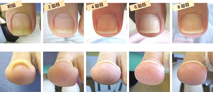 巻爪ケア｜あかり整足所