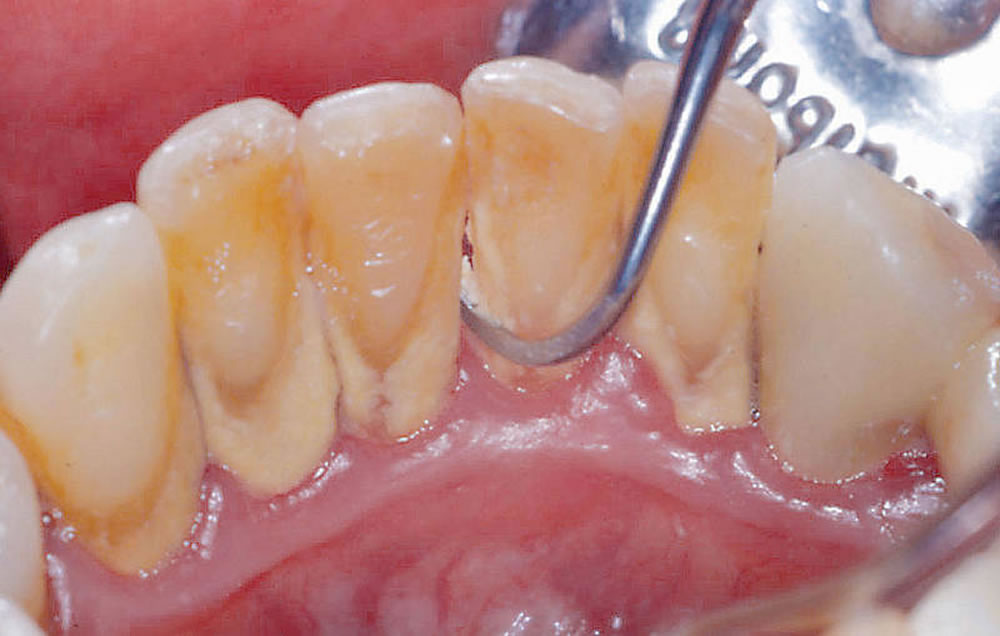 習志野市実籾で歯周病治療が評判の歯医者｜歯ぐきから血が出る｜ならし