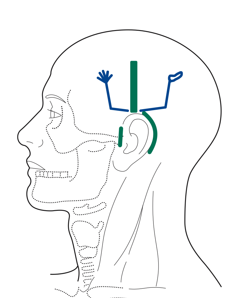 頭鍼・YNSA 山元式新頭鍼療法 三島市のコンディショニングセンター伊豆