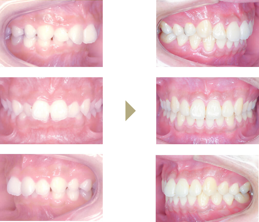保定について｜岡山じんの矯正歯科
