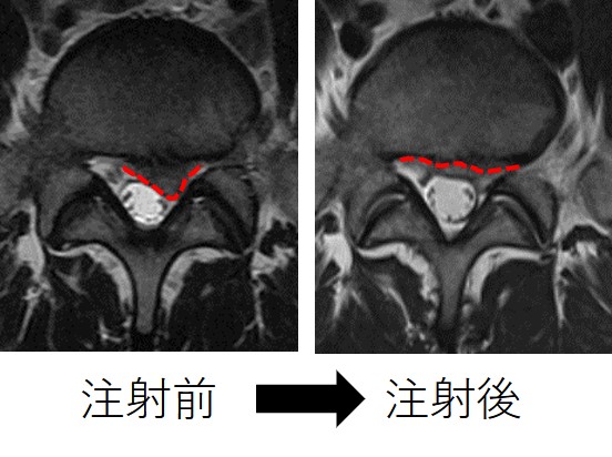 椎間板内酵素注入療法とは？ | 診療科・部門 | 浜松医療センター