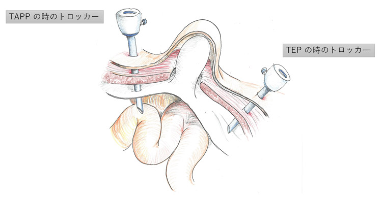 鼠径部ヘルニアの手術方法 - そけいヘルニアノート