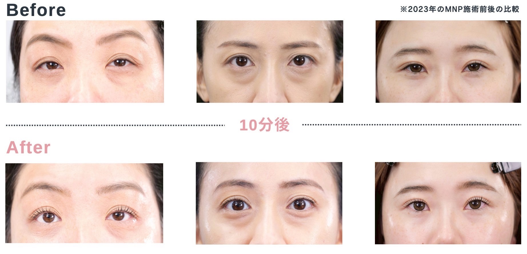 ヒロ銀座に「マンハッタンピーリフト」登場！眼科医も進める目元専門