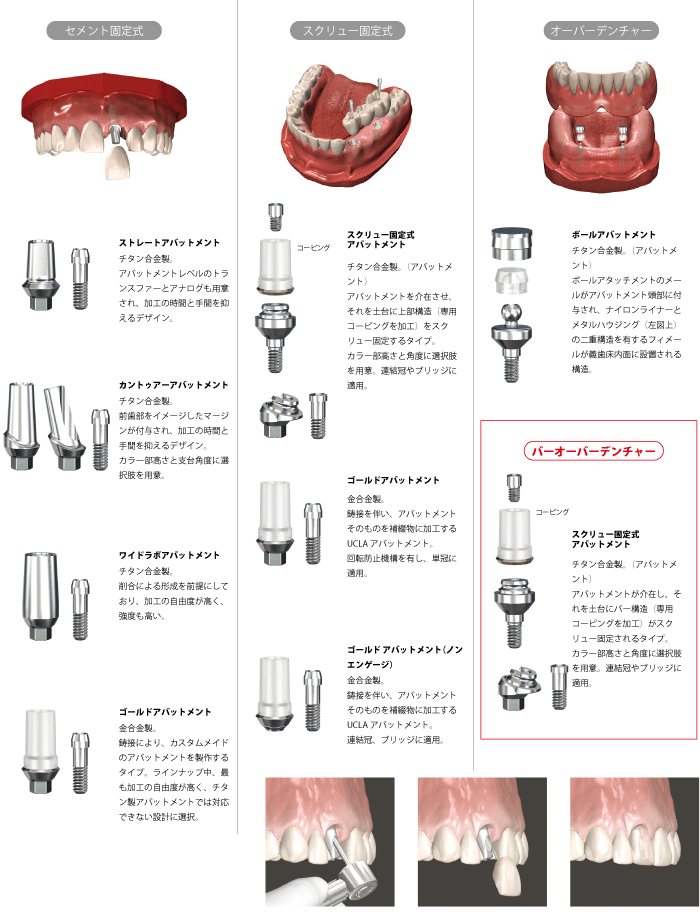 補綴術式マニュアル|株式会社インプラテックス