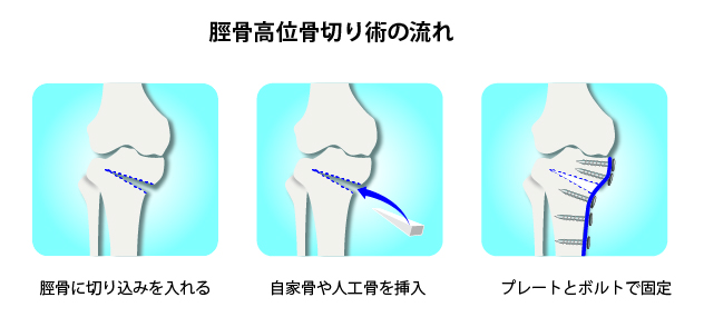 膝周囲骨切り術｜稲波脊椎・関節病院