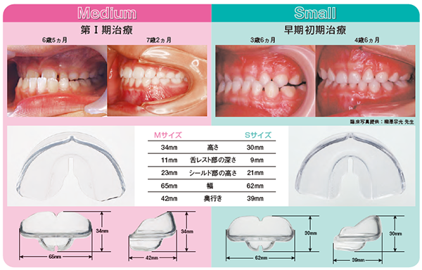 ムーシールド〔反対咬合用〕S・M《販売終了》 | 株式会社 JM Ortho