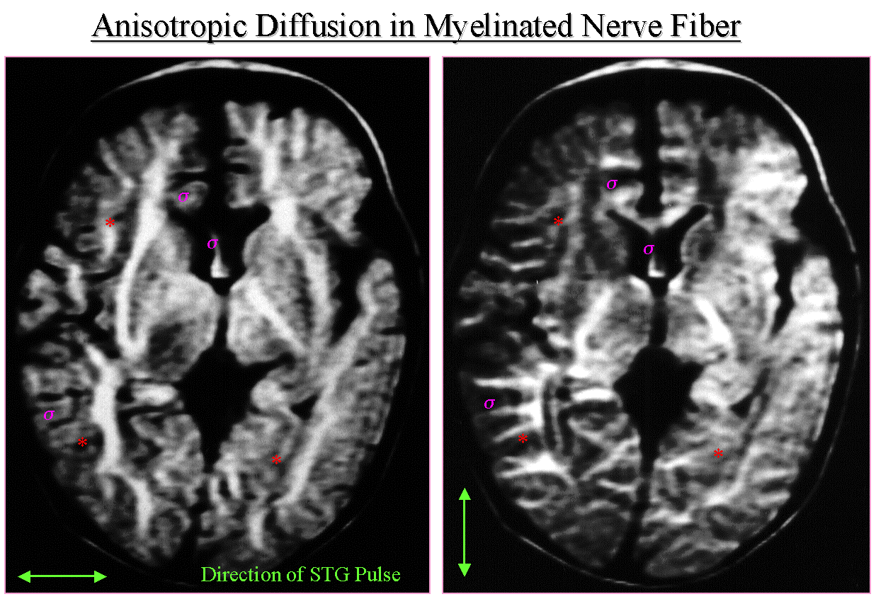 白質神経路の画像化