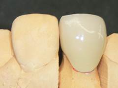 メタルセラミックス｜歯科技工所｜CADCAM冠対応｜オクヤマデンタルアート