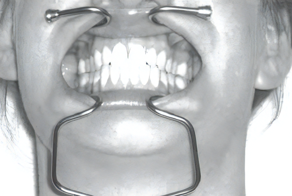 ワイヤー開口器 | 歯科用器具販売のOLAS（オーラス）