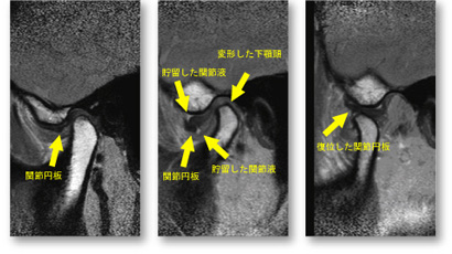 頭頸部の検査 顎関節MRI検査 | AIC八重洲クリニック