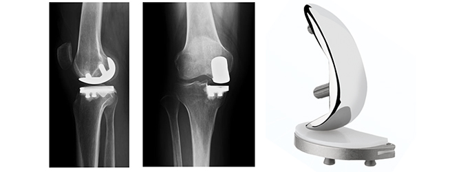 人工関節について | 人工関節センター | 愛媛大学医学部附属病院