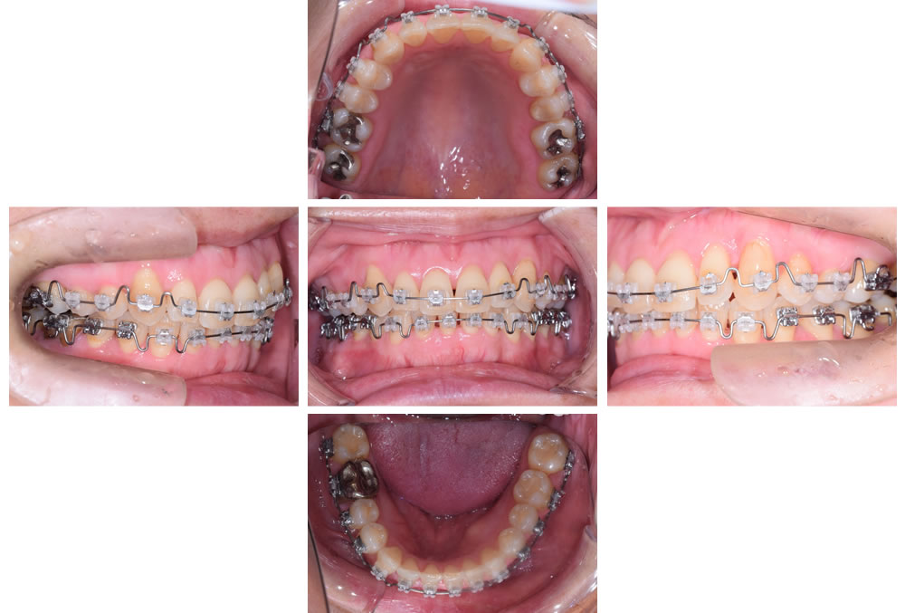 顎関節症・咬み合わせ治療｜東京銀座の歯医者｜顎関節症・咬み合わせ治療