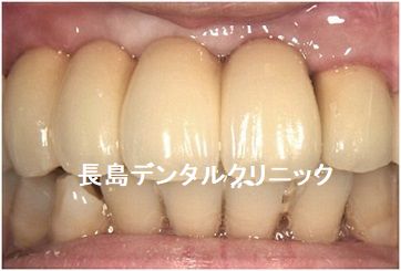 上の前歯のインプラントを撤去し、インプラントの再埋入を依頼された