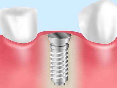 咬み合わせ・インプラント｜寝屋川市の西岡歯科クリニック