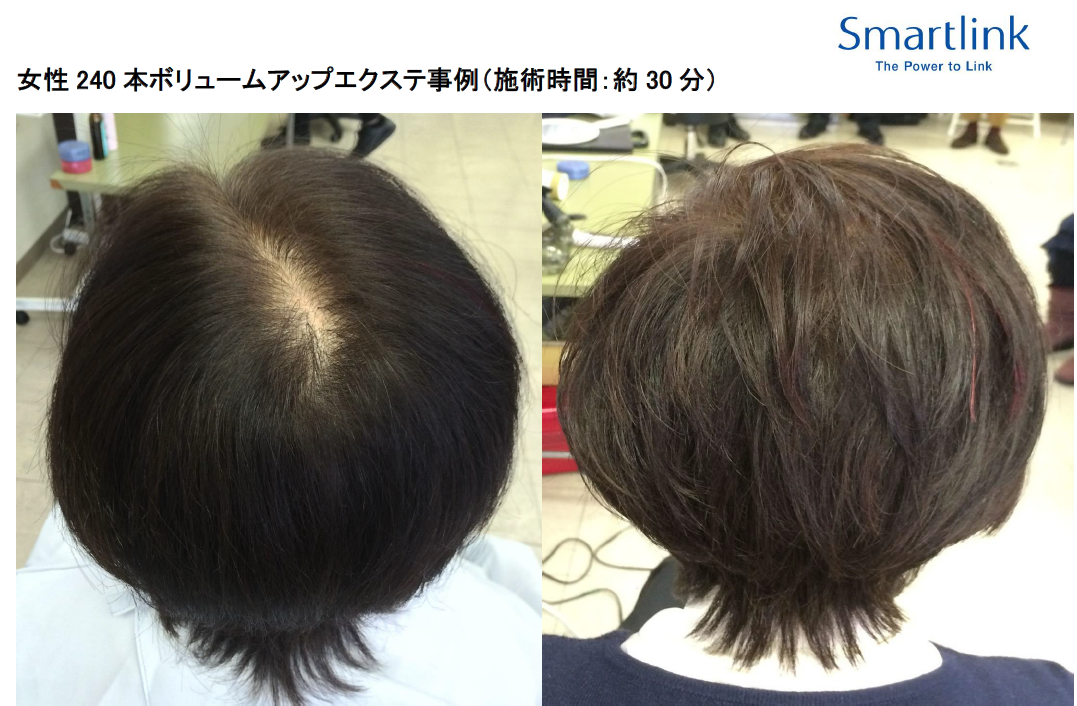 短時間ピンポイント増毛（10分で2,000本！） ｜ブログ｜増毛・かつら