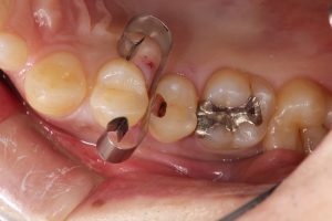 治療症例集 ｜佐伯歯科クリニック｜福岡市早良区・西新近くの「予防型