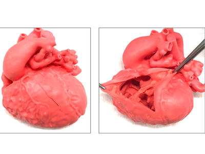 先天性心疾患3Dモデル、医師主導治験で有用性と安全性を確認－国循ほか