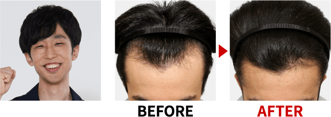 薄毛改善・発毛専門リーブ21 85.28%のお客様の抜け毛が減少 実感できる