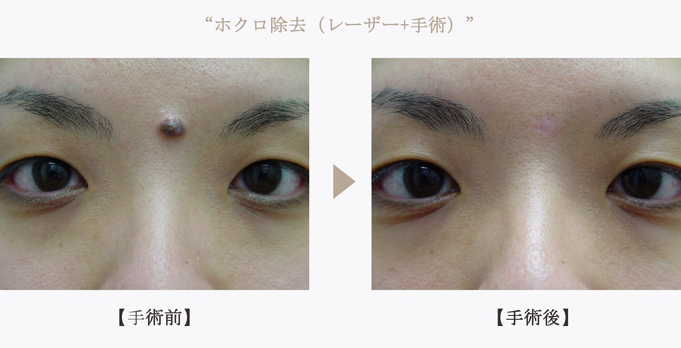 ホクロ除去（レーザー+手術）