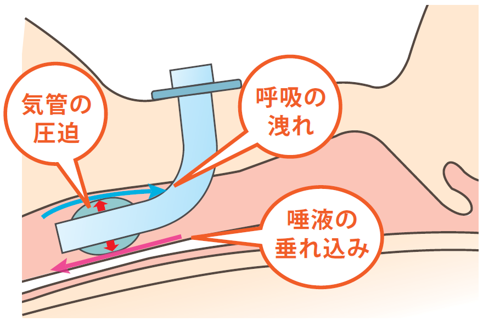 呼吸ｹｱ/ｶﾌ圧計