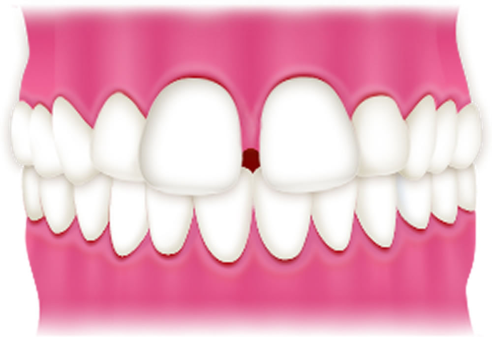マウスピース型矯正装置インビザライン｜港区麻布十番のUC矯正歯科