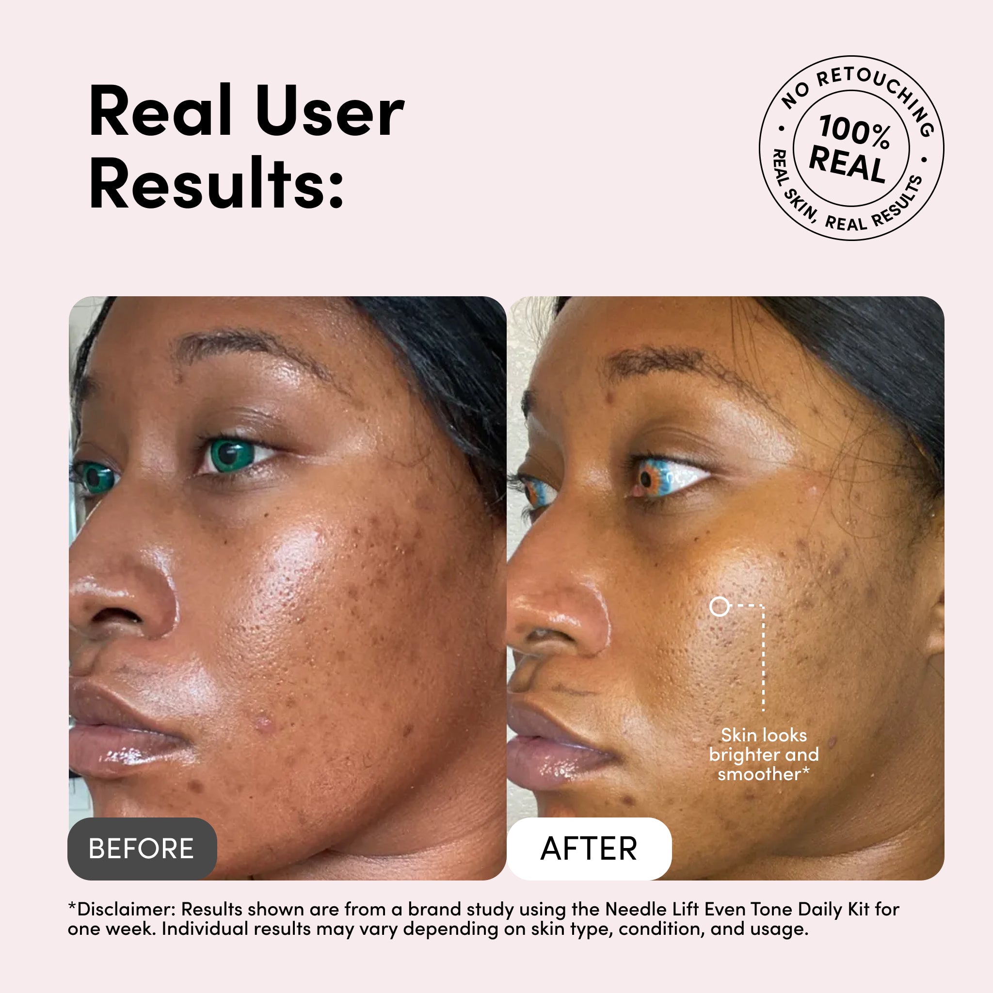 Medi Lift – Needle Lift Even Tone Daily Kit | Hydrate, Brighten