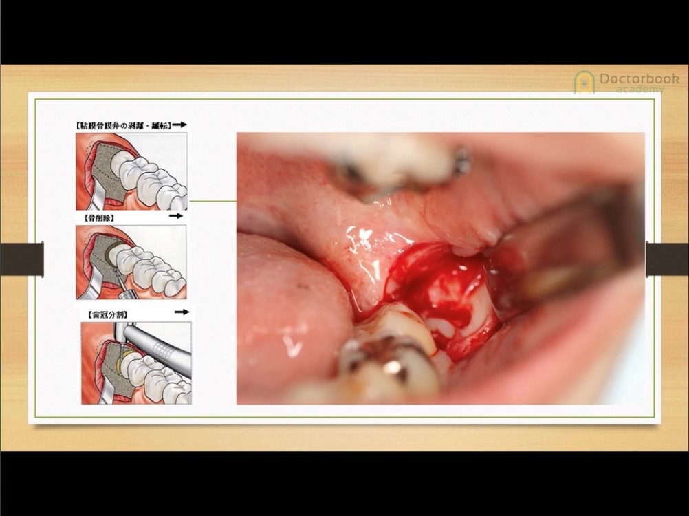 人気動画】ハマらない下顎水平埋伏智歯抜歯のポイント | Doctorbook