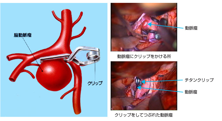 脳動脈瘤治療｜秋山脳神経外科病院