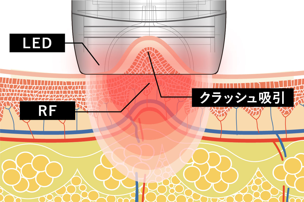 マジックポット-magicPot (複合痩身美容機器)-ラジオ波・クラッシュ
