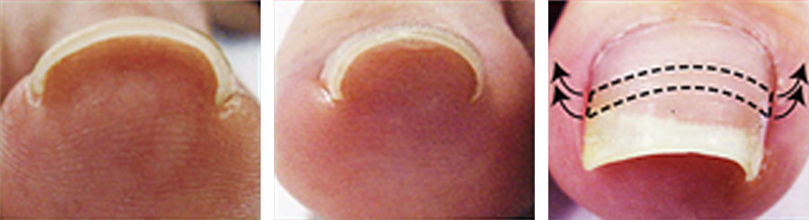 巻き爪矯正(B/Sブレイスクイック)｜ネイルサロン＆スクール キャリノ