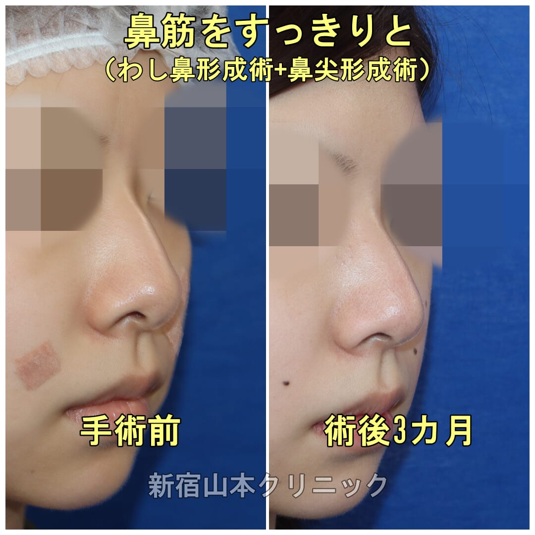 鼻先と鼻骨を手術してすっとさせる！ | 美容外科話 | 美容外科、美容