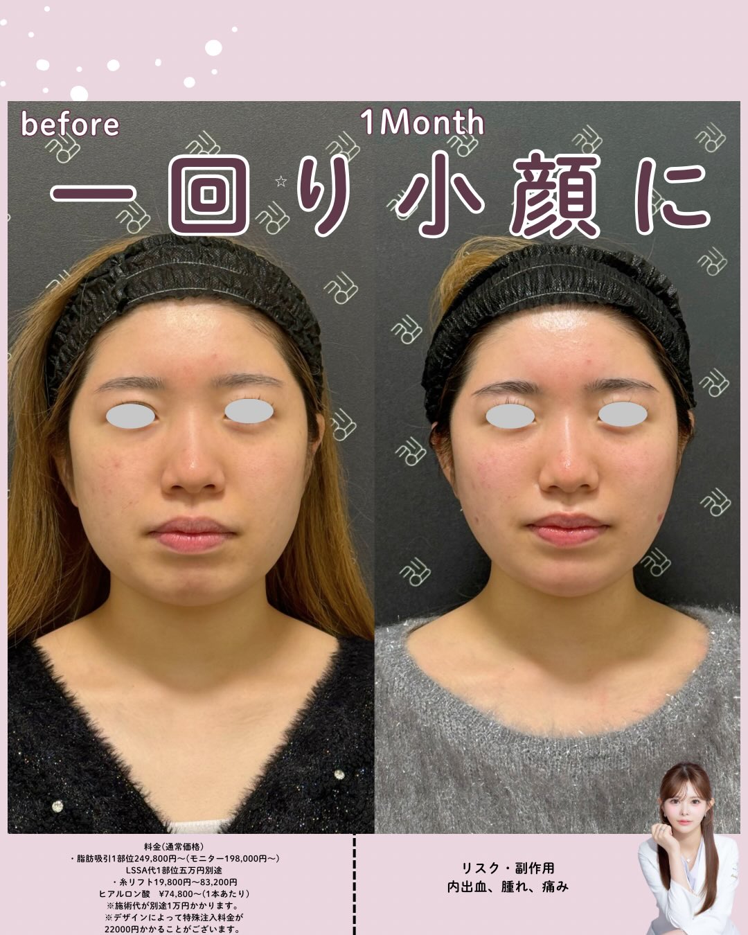 脂肪吸引（LSSA）×糸リフト×ヒアルロン酸（貴族・顎）｜No.0413 | EMMO