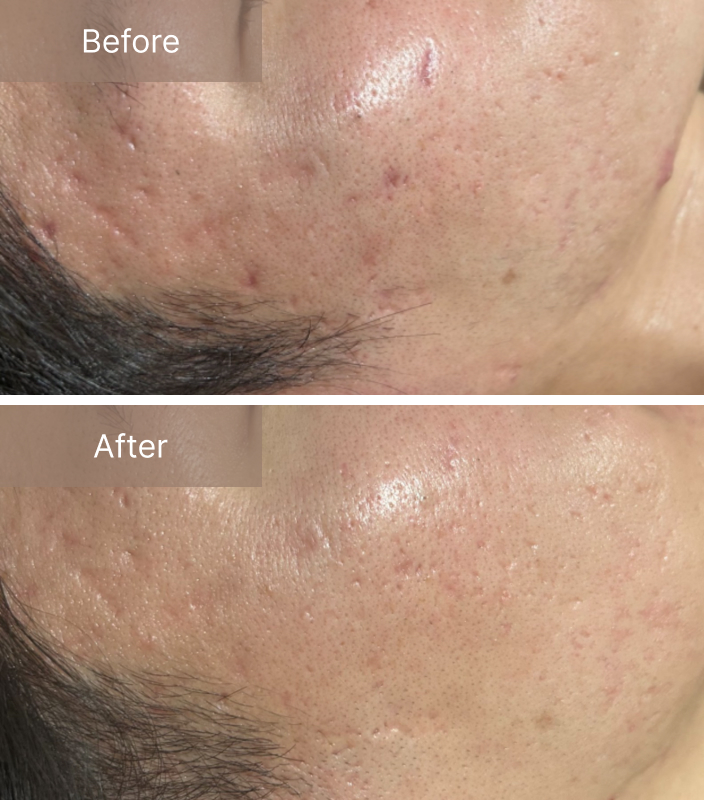 名古屋のお肌の変化を実感できるハーブピーリング専門店 エミルカ｜