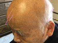 YNSA(山元式新頭針療法) - 四日市市で肩こり・腰痛に強い ふじた針灸接骨院