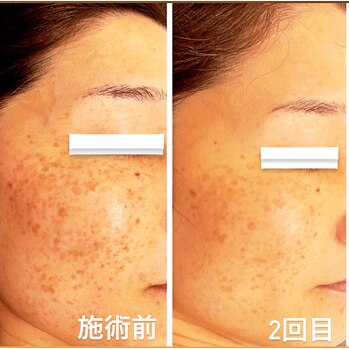 剥離あり」ハーブピーリング 施術：2回目 シミ | Genie（ジーニー）