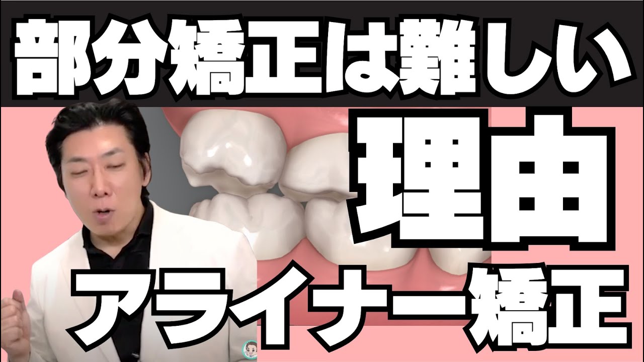 部分矯正が難しい理由について説明します〜アライナー矯正治療は奥歯が