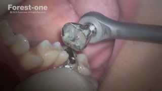 ECR(イージークラウンリムーバー) セットの通販 | Ciモール | Ciモール