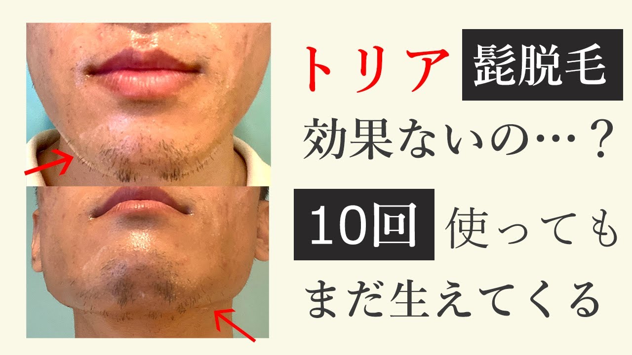 トリアは髭脱毛に効果ない？レベル5で10回脱毛した結果がヤバかった