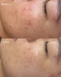 剥離なしハーブピーリングの肌変化】｜BELLIS HUIT