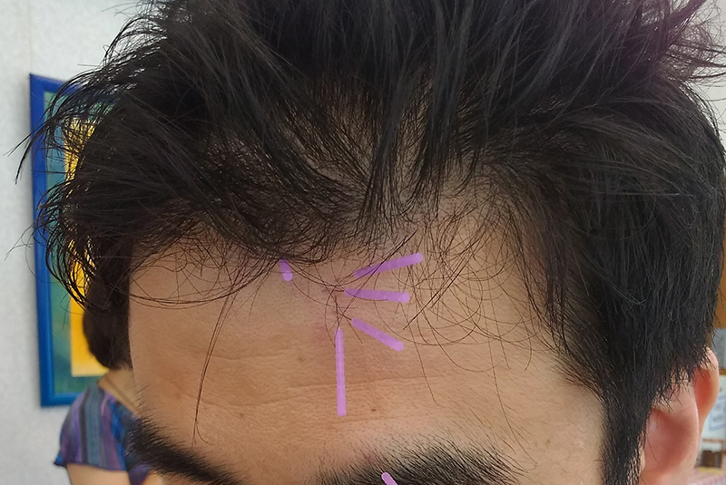 YNSA®（山元式新頭鍼療法） – きらめき訪問マッサージ