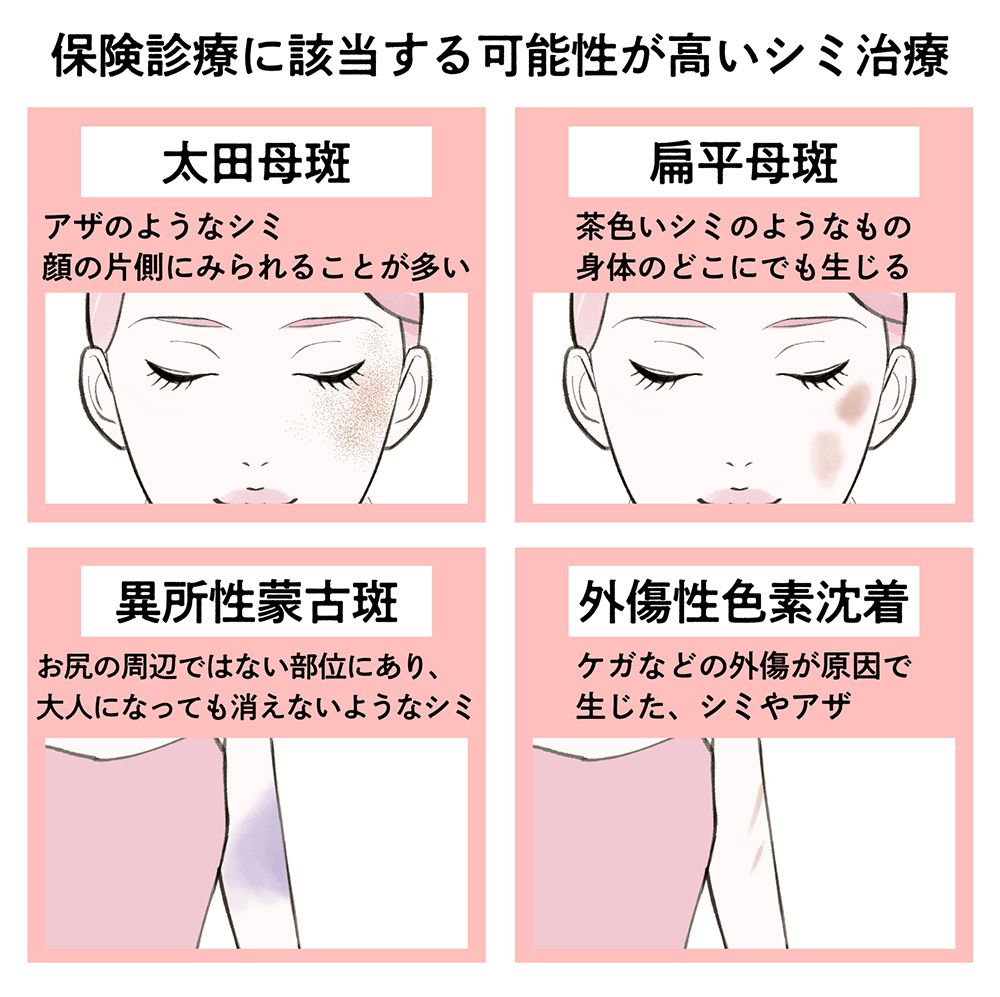 保険適用されるシミの種類は4種類。医師がシミの種類別で治療法を解説