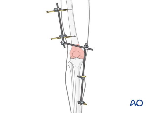 Temporary external fixator for Complete articular fracture, simple