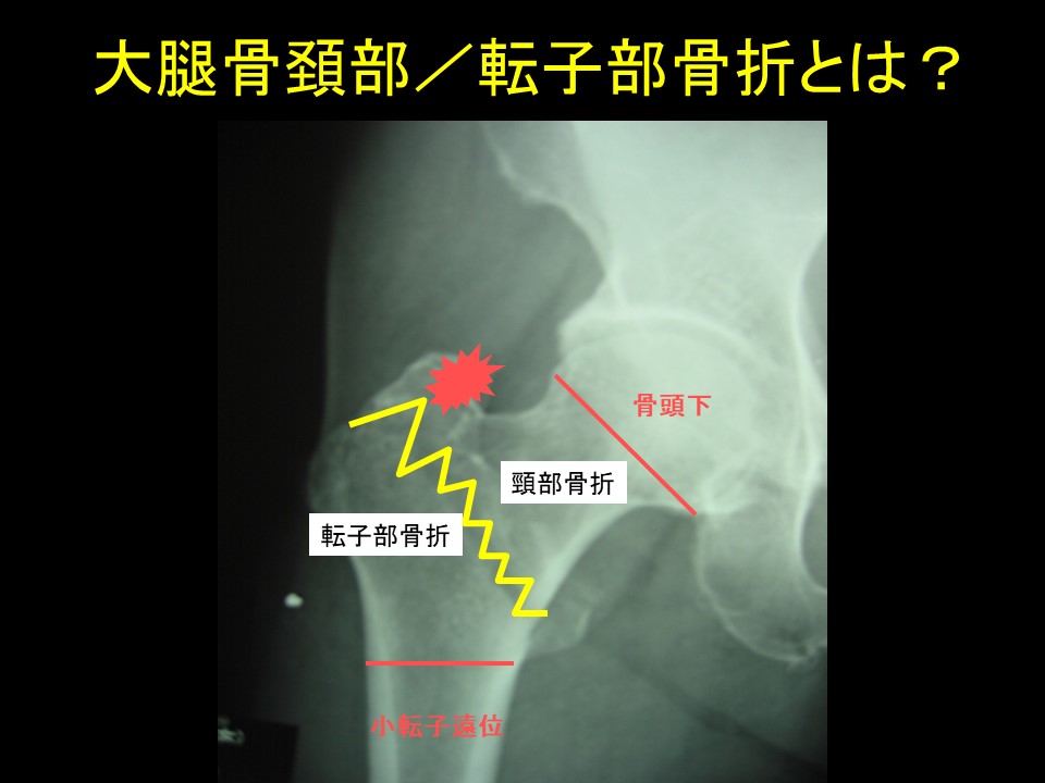 大腿骨近位部骨折には早期手術が有用！ ｜ 成尾整形外科病院