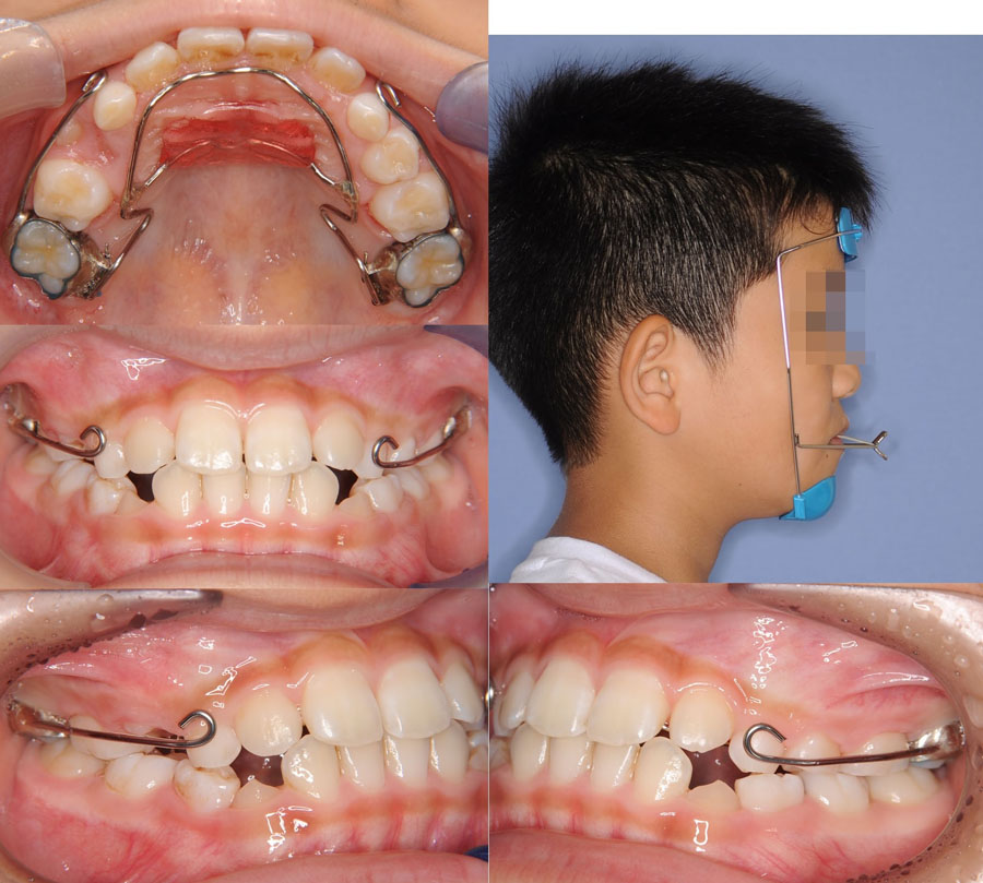 成長期の反対咬合治療例 | おかざき矯正歯科クリニック 茨城県水戸市の